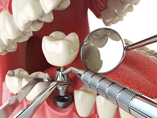 Best Emergency Wisdom Teeth Removal in Park City, TN